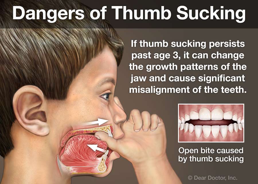 Stop Finger Sucking