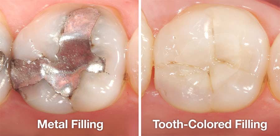 Metal fillings vs tooth-colored fillings.