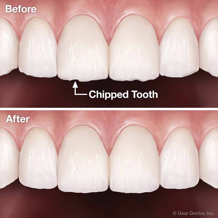 Tooth contouring and reshaping.