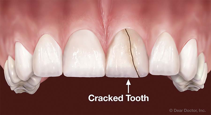 Cracked tooth.