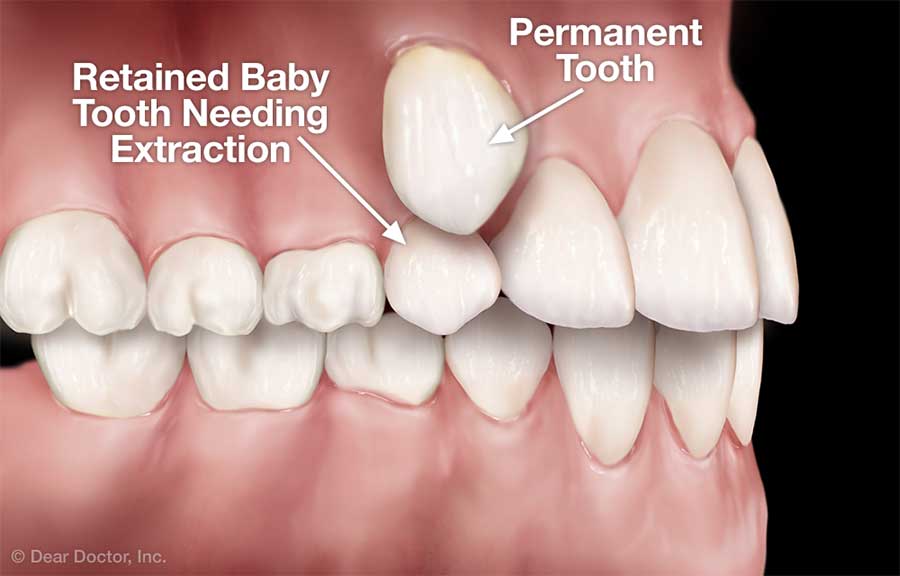 Retained baby tooth needing extraction.