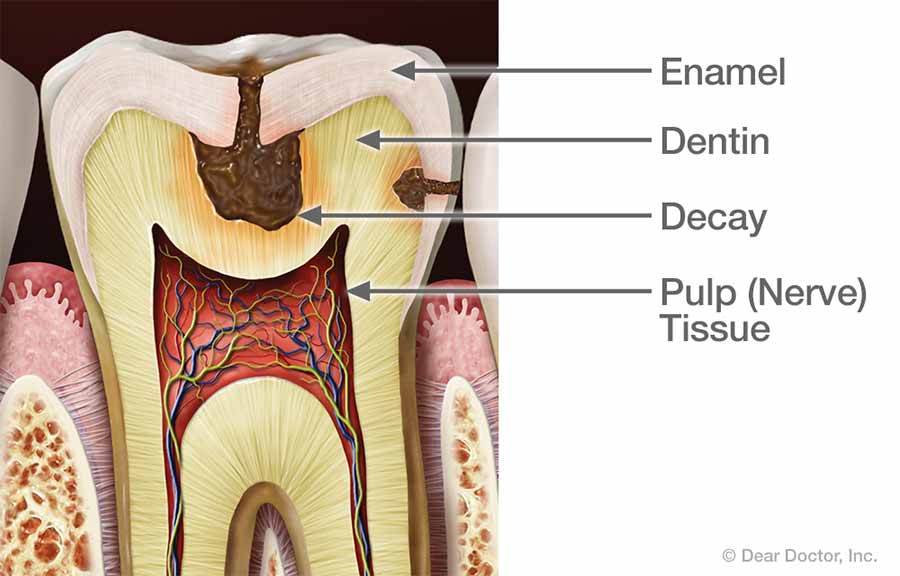 Tooth Decay.