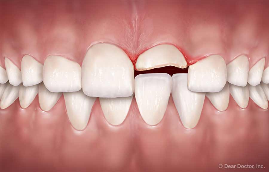 Traumatic dental injuries | the children’s choice pediatric dentistry