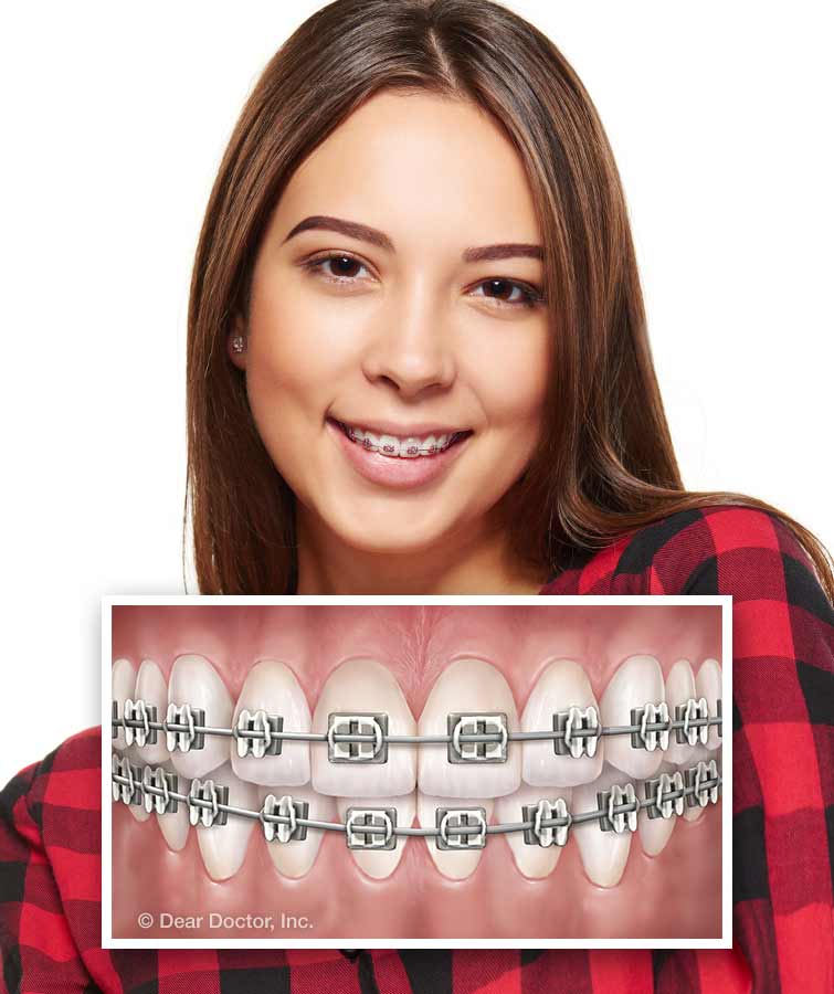 Types Of Braces Sweeney Orthodontics North Olmsted Ohio 