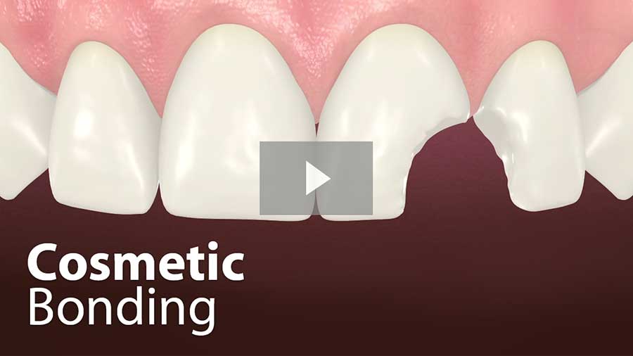 Dental Bonding Video  Tooth Bonding 