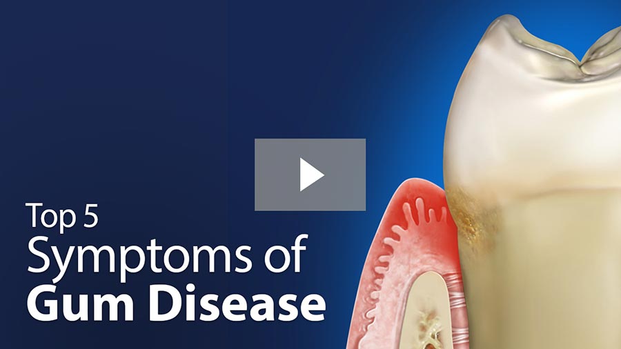 Top 5 Symptoms of Gum Disease video