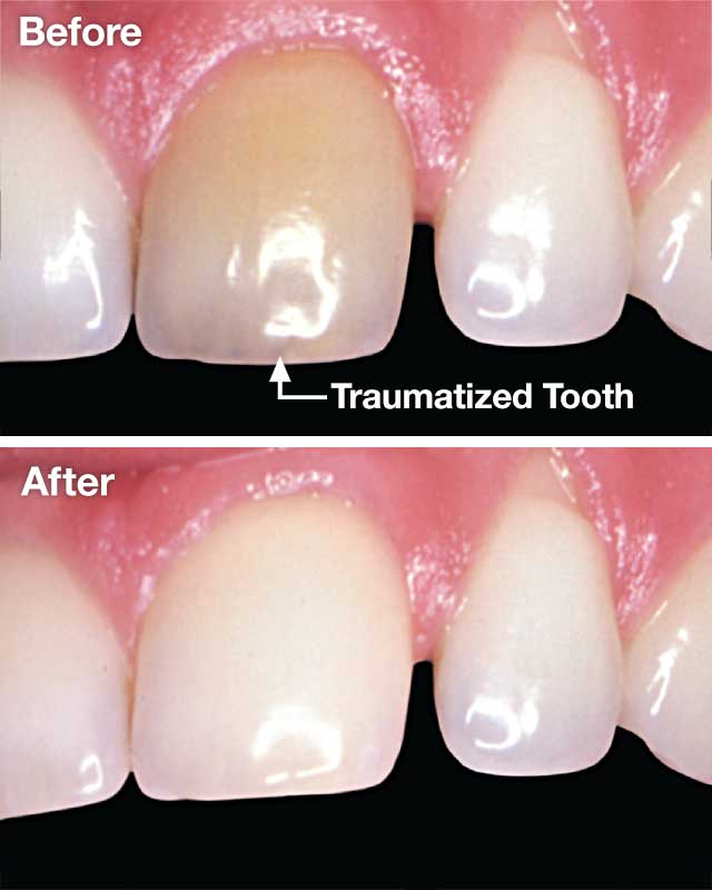 Whitening traumatized teeth.