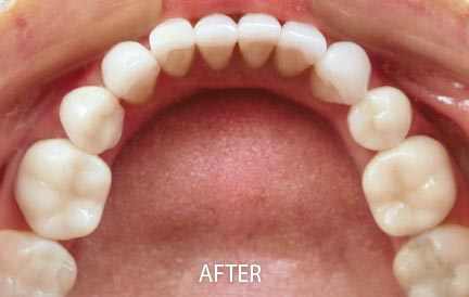 After Invisalign treatment.