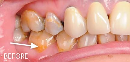 Antibiotic tetracycline tooth staining.