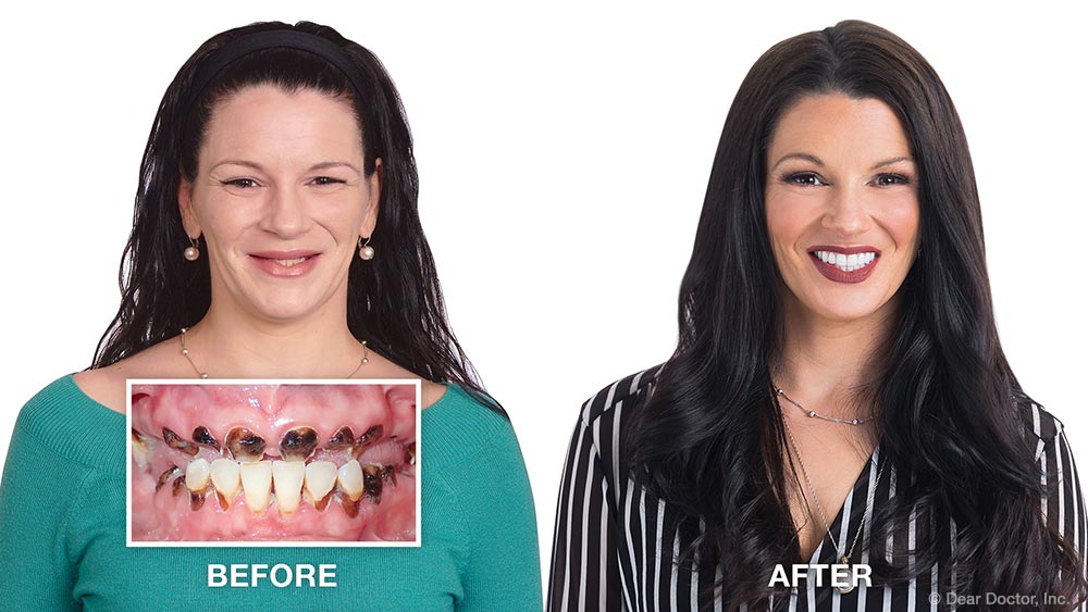 Cara smile makeover before and after.