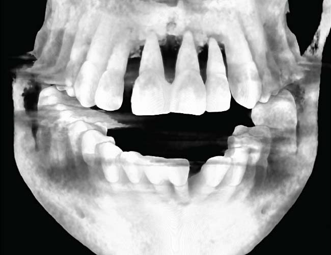 Celeste CAT scan x-ray showing extensive bone loss (front).