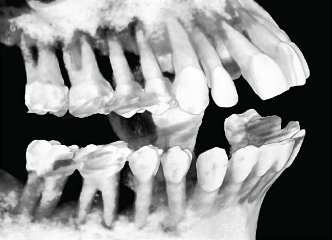 Celeste CAT scan x-ray showing extensive bone loss (left).