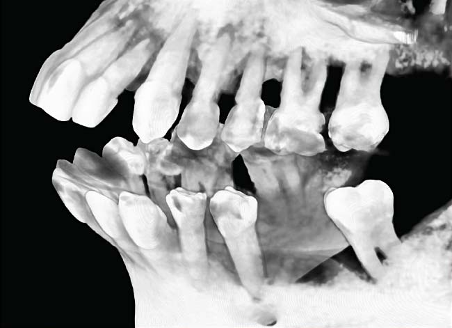 Celeste CAT scan x-ray showing extensive bone loss (right).