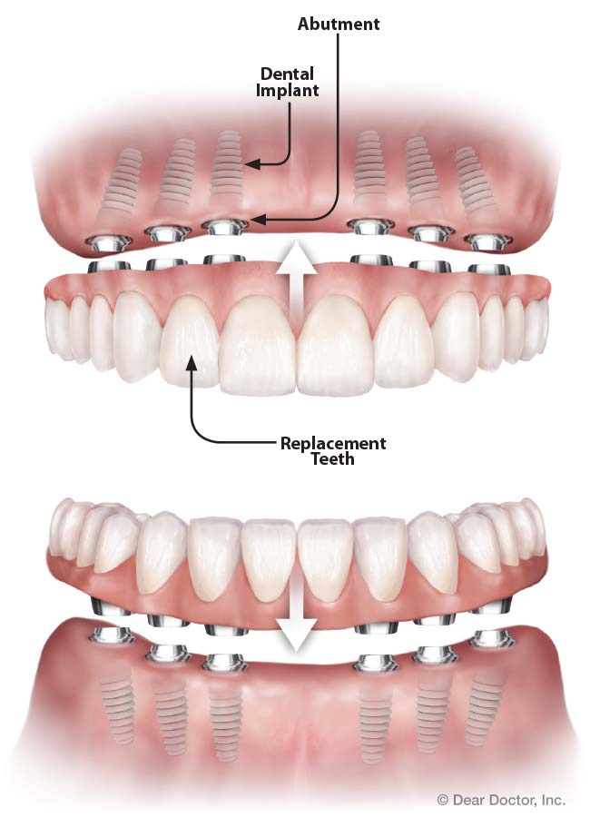 Celeste implant-supported teeth.