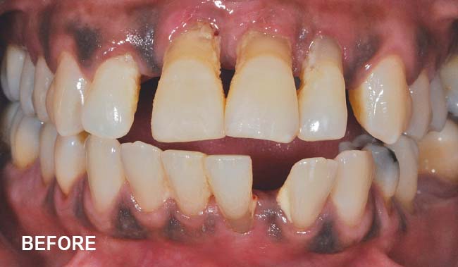 Celeste before treatment - periodontal disease.