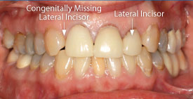 Congenitally missing lateral incisor.