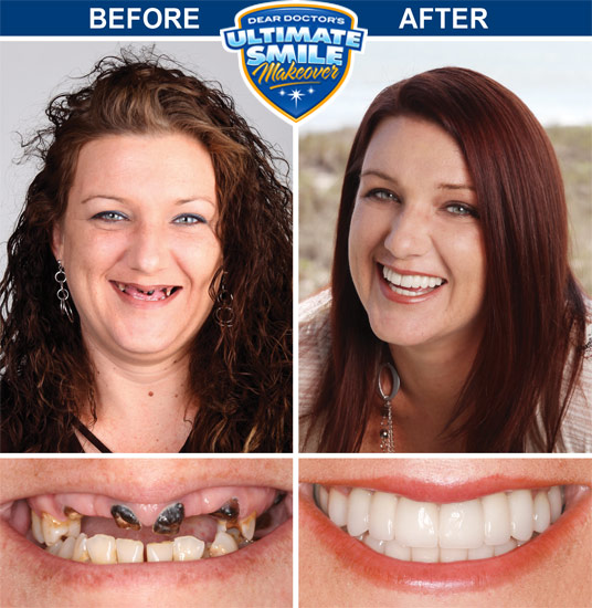 Smile makeover before and after.