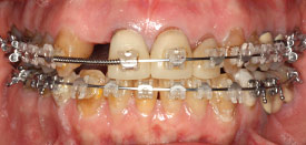 During orthodontic braces treatment.