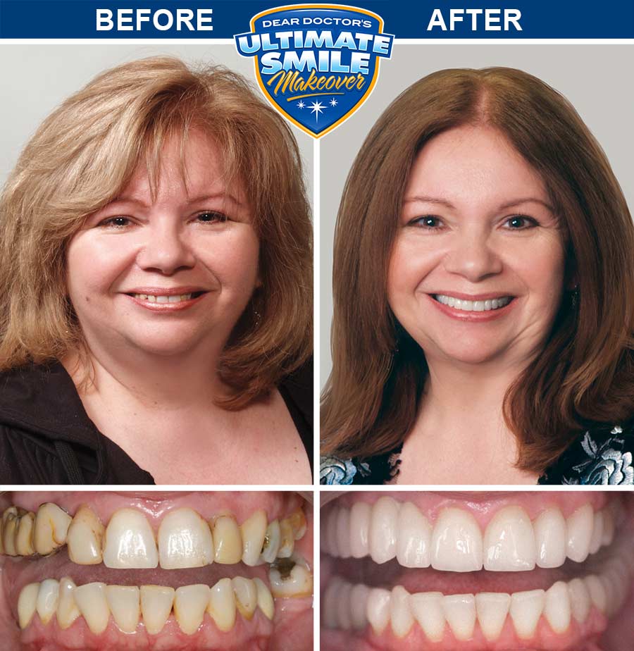 Smile Makeover Contest Winner Debra Cosmetic Dental Makeover