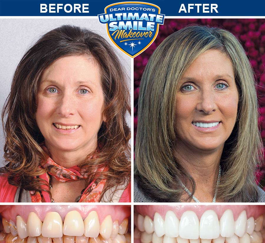 Smile makeover before and after - Sue.