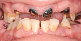 tooth decay before smile makeover.