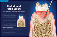 Periodontal Flap Surgery - Dear Doctor Magazine