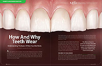 Teeth Wear - Dear Doctor Magazine