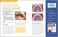 Tooth Removal - Dear Doctor Magazine