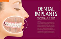 Dental Implants - Dear Doctor Magazine Dental Implants - Dear Doctor Magazine